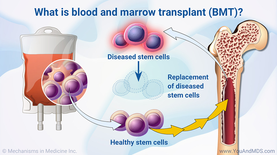 Slide Show Blood And Marrow Transplantation In MDS